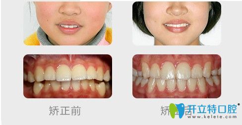 成人深覆蓋矯正案例效果對比照