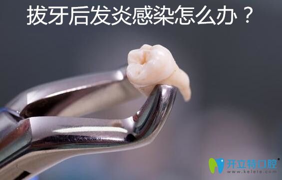 拔牙后發(fā)炎感染了怎么辦？感染癥狀有哪些你知道嗎？