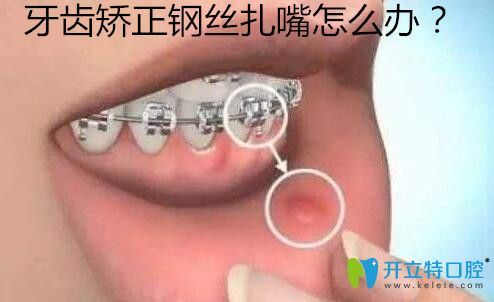 金屬托槽牙齒矯正鋼絲扎嘴磨嘴怎么辦？