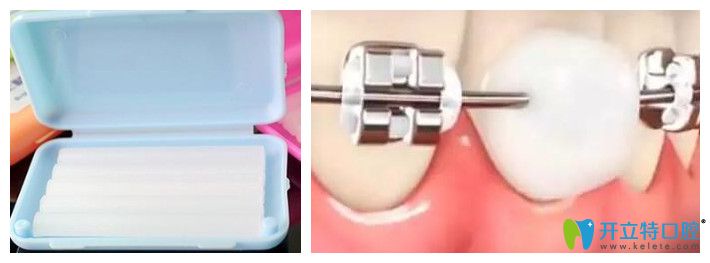 牙齒矯正鋼絲扎嘴用正畸蠟