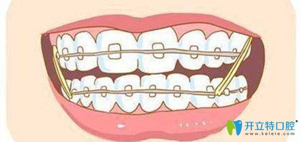 牙齒矯正時(shí)間的長短與那些因素有關(guān)