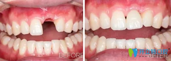 深圳深圳諾德口腔士卓曼種植牙效果圖