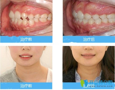 中山美南華牙科中心對刃頜矯正效果圖 中山美南華牙科中心對刃頜矯正效果圖