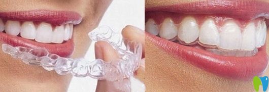 隱形牙齒矯正器示意圖