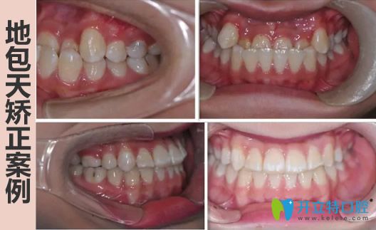 中山美南華地包天牙齒矯正前后對比照 中山美南華地包天牙齒矯正前后對比照