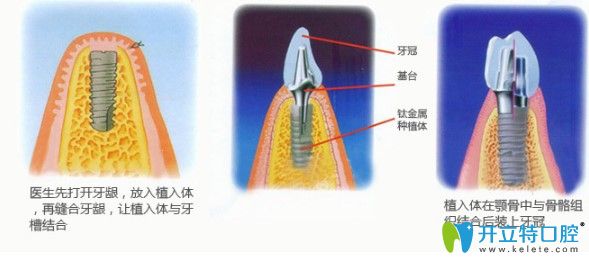 中山美南華牙科主任江會昇解說種植牙術(shù)后注意事項 中山美南華牙科主任江會昇解說種植牙術(shù)后注意事項