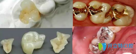 牙齒嵌體修復(fù)效果圖