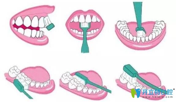 梅州中大口腔醫(yī)生科普種植牙術后清潔方法