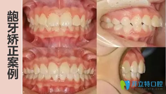 中山美南華口腔牙性+骨性齙牙矯正案例 中山美南華口腔牙性+骨性齙牙矯正案例