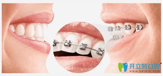 中大口腔何虹講解牙齒矯正的好處 中大口腔何虹講解牙齒矯正的好處