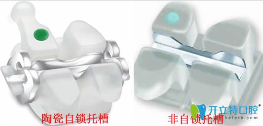 陶瓷牙套太厚是其劣勢但不是容易掉的原因