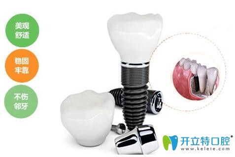 梅州中大口腔何虹科普種植牙優(yōu)勢(shì) 梅州中大口腔何虹科普種植牙優(yōu)勢(shì)