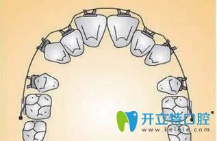 陶瓷牙套為什么容易掉?是因?yàn)樘沾勺枣i托槽太厚了?不盡然吧