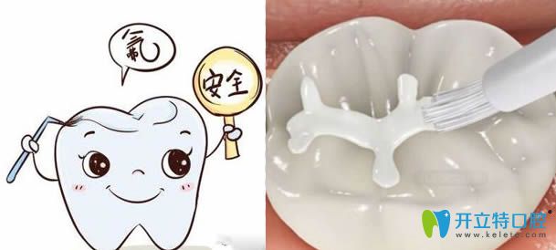 兒童防齲齒-做了窩溝封閉后還需要做涂氟嗎？能同時做嗎?