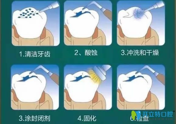 窩溝封閉治療過程圖示