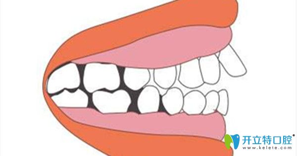 如何判斷是否是牙槽骨突出