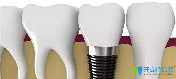 種植牙包含基臺、種植體、牙冠