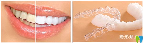 冷光美白與隱形矯正技術(shù)