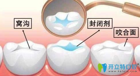 窩溝封閉和涂氟能一起做嗎