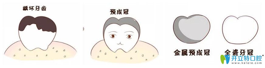 兒童乳牙預(yù)成冠是什么？比樹脂填充好在哪里？