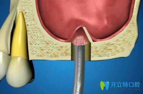 上頜竇外提升術(shù)示意圖