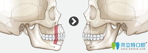武漢正璞口腔醫(yī)生告訴你怎么確定是牙槽骨突出