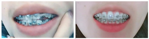 矯正虎牙需要多久？看我在武漢正璞口腔正畸第165天的效果