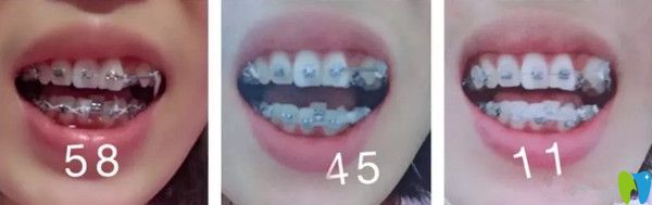 牙齒矯正1-2個(gè)月的變化圖