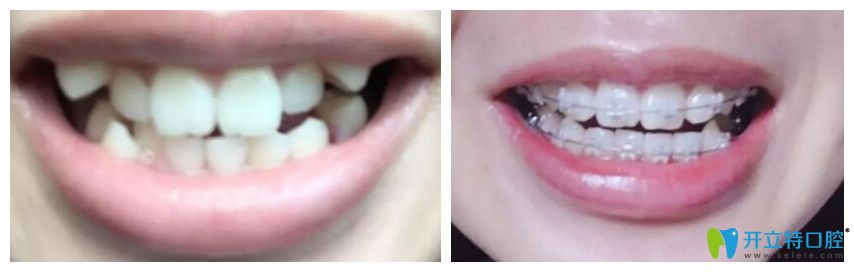 廣州壹加壹口腔靠譜嗎?聽(tīng)聽(tīng)牙齒擁擠和虎牙矯正顧客怎么說(shuō)