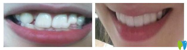 長沙中諾口腔隱形矯正案例