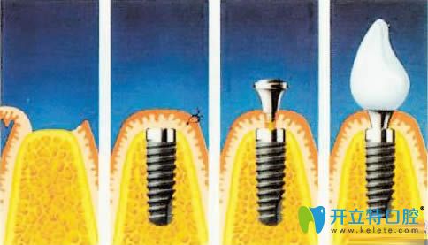 候國鎮(zhèn)醫(yī)生擅長各類種植牙手術(shù)