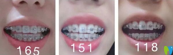 口腔正畸半年后的效果圖