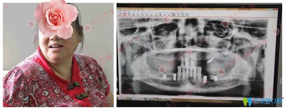 廣州種植牙醫(yī)院哪家好？廣大口腔顧客種植牙真人案例來驗證