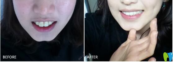 團圓口腔矯正案例對比圖