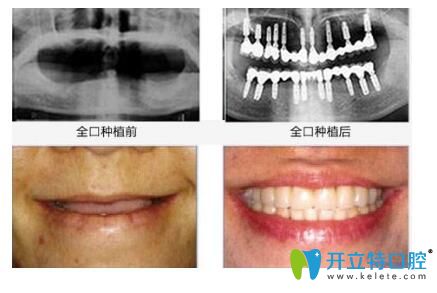 德韓口腔種植牙前后效果對比圖