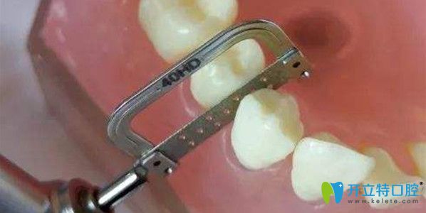 鄰面去釉后悔了，哪些情況可以做鄰面去釉？