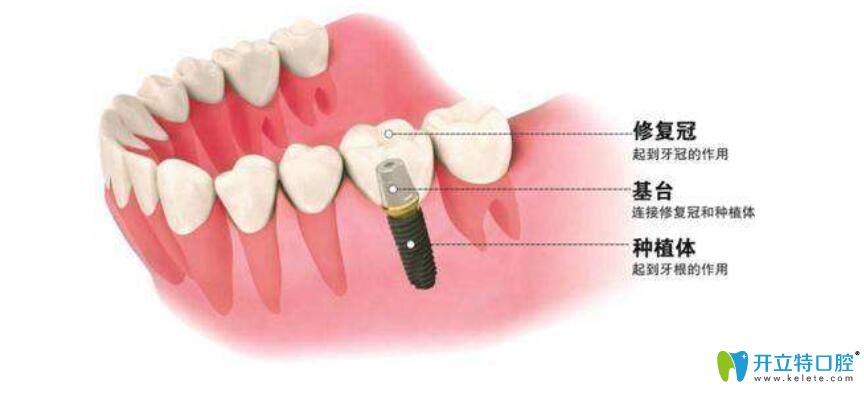 了解種牙牙冠價(jià)格前，先弄清楚種植牙牙冠有哪些種類