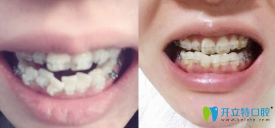 杭州時(shí)光口腔陶瓷牙套矯正1個(gè)月照