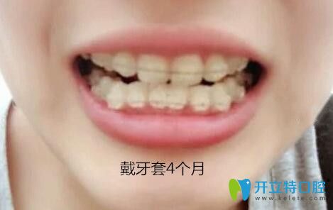 我在梅州中大口腔做牙齒矯正第4個(gè)月 我在梅州中大口腔做牙齒矯正第4個(gè)月