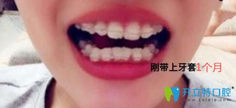 我在梅州中大口腔做牙齒矯正第1個(gè)月 我在梅州中大口腔做牙齒矯正第1個(gè)月