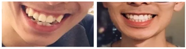 2年前在南京月牙兒口腔做矯正齙牙,看我卸掉牙套后的變化