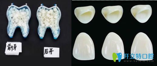 磨完牙要戴的臨時(shí)牙冠圖