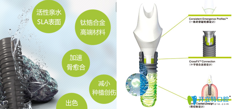 瑞士iti種植體優(yōu)勢