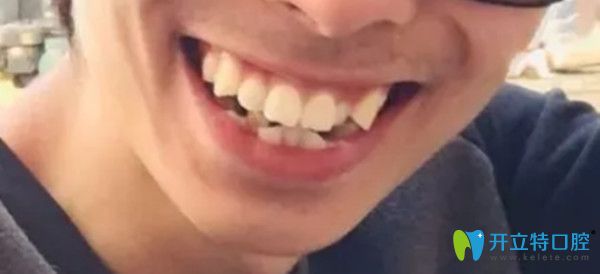 齙牙矯正前的照片