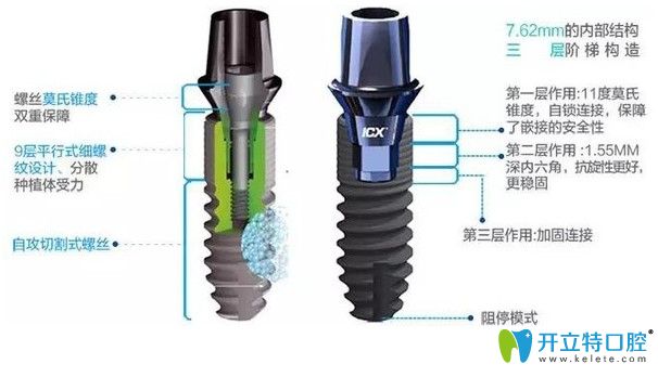 德國icx種植體優(yōu)點(diǎn)