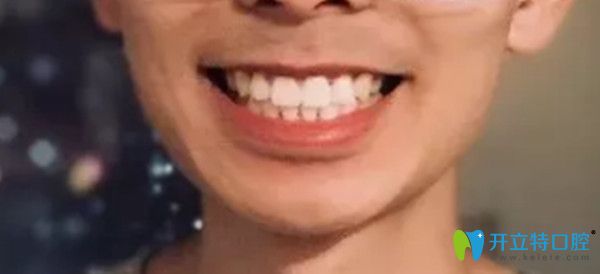 齙牙矯正前后對(duì)比圖