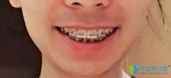 半隱形矯正一年后的變化圖