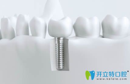 韓國(guó)種植牙品牌介紹