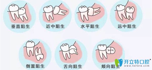 七種阻生智齒的樣子 七種阻生智齒的樣子