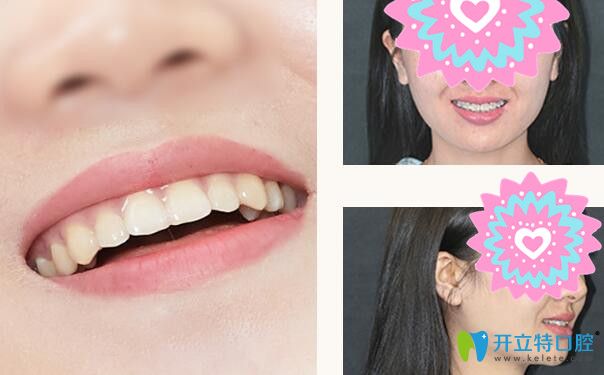 格倫菲爾口腔牙齒前突矯正案例前后效果對(duì)比